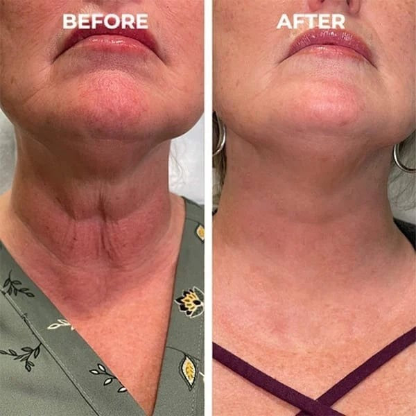 SkinKart® | Botox Skin Tightening Young Serum