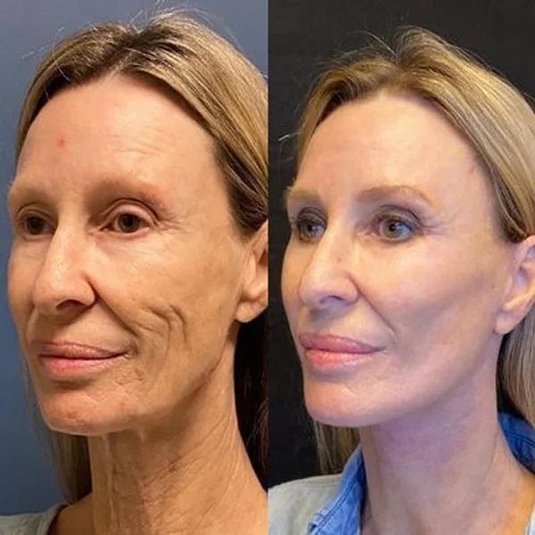 SkinKart® | Botox Skin Tightening Young Serum